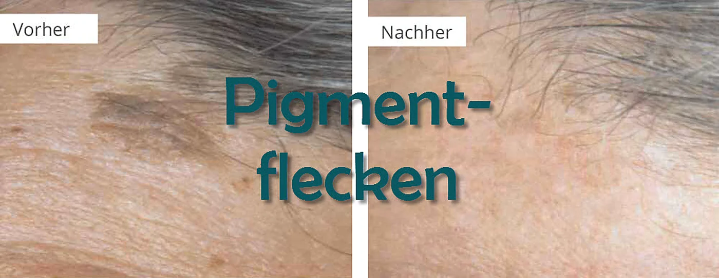 Pigmentflecken & Alterswarzen